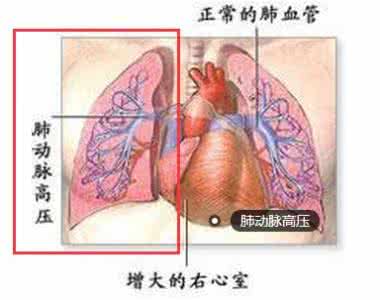 肺动脉高压能治好吗 肺动脉高压能治好吗 怎么预防肺动脉高压