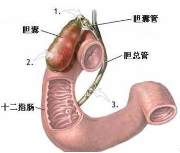 胆囊摘除后遗症 胆囊摘除后遗症 胆囊摘除后遗症 胆囊摘除对患者的影响