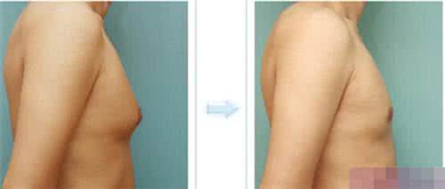 乳房发育不好咋办 男生胸部发育原因竟是吃了这些