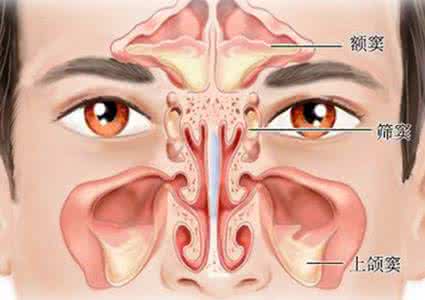 鼻窦炎的最好治疗方法 鼻窦炎内服方