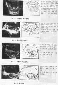 传销的种类及应对方式 如何正确应对7种流产方式？：1、先兆流产