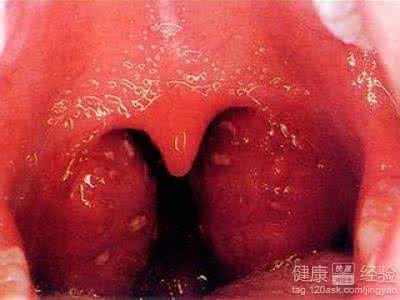 咽炎和扁桃体炎的区别 朱仙舟治疗咽炎、扁桃体炎及脓肿验方
