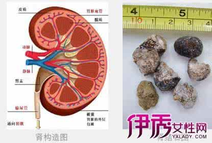 肾结石的病因 肾结石的病因 肾结石的病因与治疗