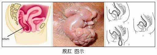 脱肛的最佳治疗方法 疾病预防 脱肛的最佳治疗方法 食疗也可治脱肛