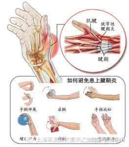 腱鞘炎的治疗与康复 腱鞘炎的治疗与康复 康复丨腱鞘炎的贴扎技巧