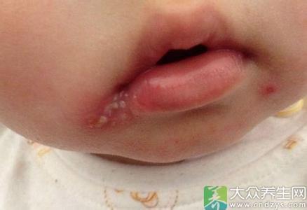 湿疹用什么药效果好 中医治疱疹效果好 袍疹奇效