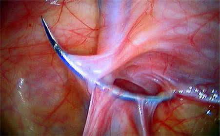 疝气手术前注意事项 疝气手术 术前术后有哪些注意事项