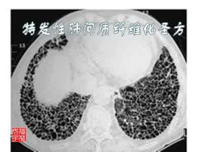 名医珍藏秘方大全 名医秘方：真性红细胞增多根治圣方龙胆汤