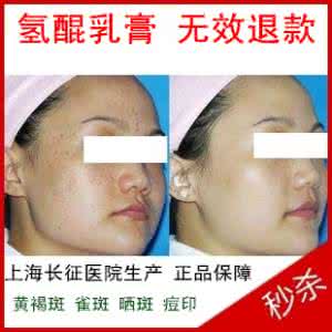 氢醌霜能治黄褐斑吗 去黄褐斑用氢醌霜还是氢醌乳膏好 有什么要注意