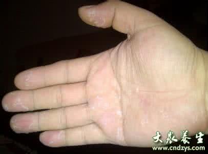 宝宝手指脱皮 手指脱皮 手指脱皮 发生在宝宝身上太可怕