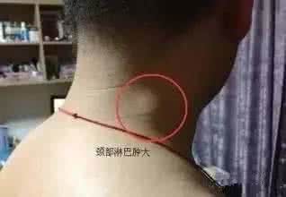 细节决定生死安危 这三处淋巴决定生死，没事摸它能长寿。