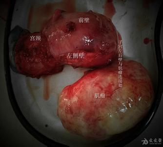 子宫肌瘤切除后症状 40岁后出现这症状可能切除子宫