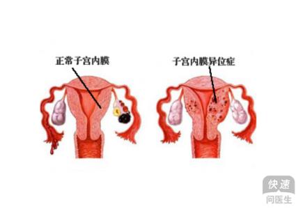 子宫内膜厚该怎么办 子宫内膜异位该怎么办 子宫内膜厚不好怀孕,那该怎么办呢?
