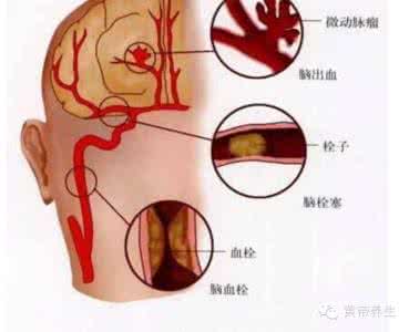 脑血栓前兆 微信 脑血栓前兆 当天6个暗号 为了亲人看一眼