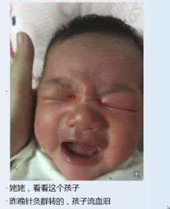 补充眼睛营养 孕妇高度营养导致婴儿眼睛出血