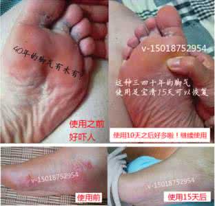 达克宁治脚气效果好吗 治脚气的西药方 使用效果达克宁之类好多了
