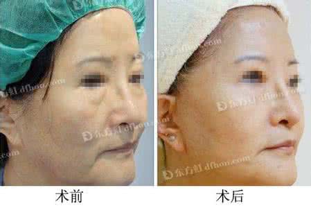 电波拉皮价格 电波拉皮好吗 电波拉皮价格是怎么样的