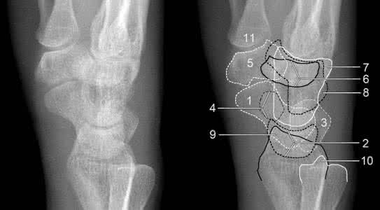 腕关节脱位 腕关节脱位 腕关节脱位读片技巧