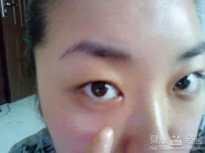 怎样治疗麦粒肿 麦粒肿治疗 怎样治疗麦粒肿？