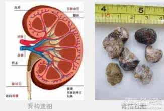 治肾结石最有效的秘方 肾结石严重吗 有效治愈肾结石