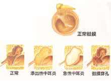 中耳炎用药 中耳炎用药 中耳炎一般用药5次即可全愈