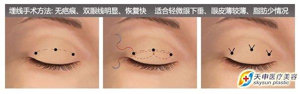不开刀的双眼皮手术 不开刀的双眼皮手术 双眼皮手术不满意怎么办？