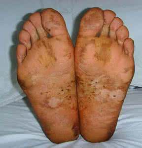 脚癣怎么根治土方法 脚癣怎么根治土方法 治脚癣的方法都是什么