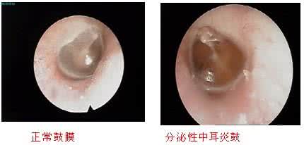 治中耳炎吃什么消炎药 中耳炎吃什么药 治好你的中耳炎