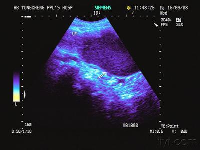 女孩子为什么会来月经 女孩处女膜闭锁会有月经吗?