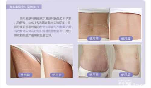 菲林美姿祛疤精油 精油的使用方法 去疤精油的使用方法