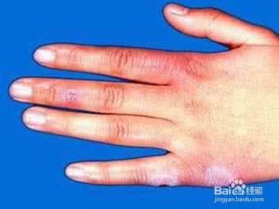 怎样预防冬天手生冻疮 怎样预防冻疮 这个冬天让你不再起冻疮