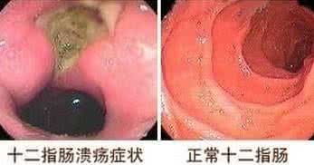 十二指肠溃疡吃什么药 十二指肠溃疡症状 它的症状是什么