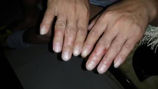 治疗手足癣的最佳偏方 有什么办法治疗手足癣 足癣治疗的偏方说明