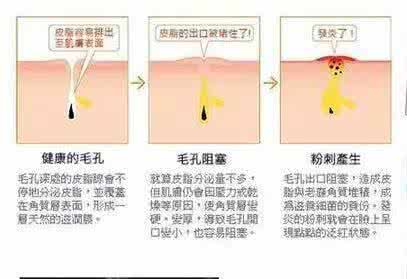 青春痘粉刺的症状 粉刺是什么症状 有哪些护理方法