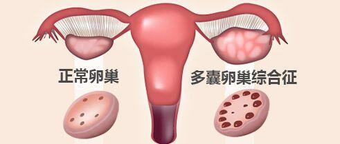 治疗多囊卵巢多少钱 多囊卵巢综合症治疗 怎么样治疗多囊卵巢