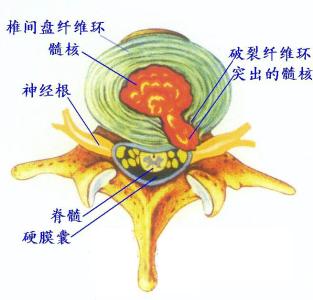 日常饮食如何养脾胃 腰椎间盘突出饮食 日常饮食如何合理安排