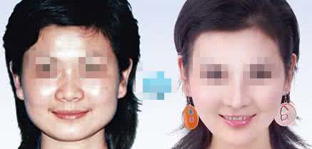 光子嫩肤祛斑效果 光子祛斑怎么样 光子嫩肤祛斑的效果怎么样