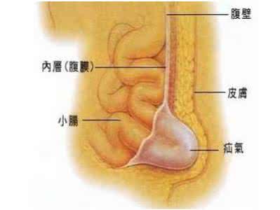 肾病综合症食谱 【民间偏方】治小儿龟头炎、脱肛、疝气、肾病综合症的偏方