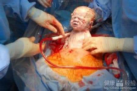 剖宫产后吃什么好 剖宫产后吃什么 剖腹产后5天内吃什么好