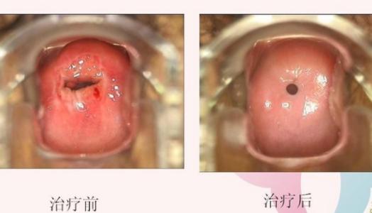 宫颈炎吃什么药好 宫颈炎吃什么药 治好你的宫颈炎