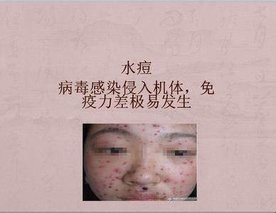 外阴长水痘怎么办 水痘长在外阴怎么止痒?