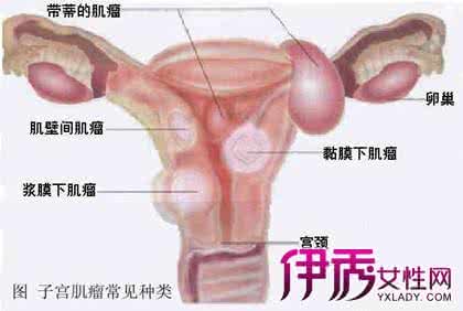 怀孕后为何长子宫肌瘤 子宫肌瘤还能怀孕吗 子宫肌瘤除后还能再长吗？