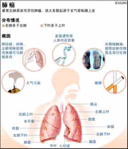 肺癌的早期症状有哪些 肺癌早期症状 六大症状要当心