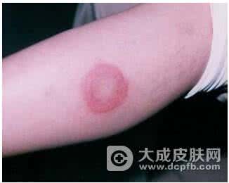 红斑狼疮早期症状 红斑狼疮早期症状 4个征兆暗示SLE来袭