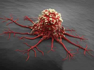 良性肿瘤也有带毛刺的 原来肿瘤也有克星