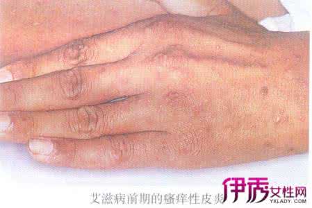 艾滋病治得好吗 得了艾滋病还能治好吗?