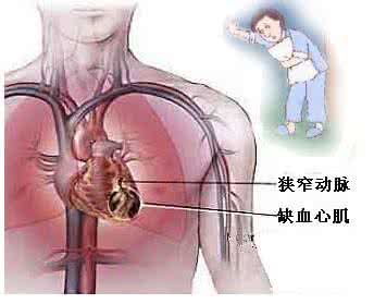 心绞痛是心脏病吗 心脏病，心绞痛发作，按揉两穴应急保命!