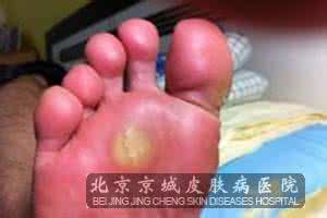 激素脸的正确治疗方法 鸡眼病的正确治疗方法