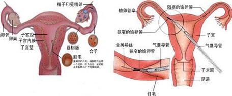 输卵管疏通手术流程 输卵管疏通手术流程 输卵管疏通