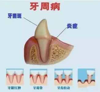 牙周病为啥不能吃海鲜 不能忽视的牙周病